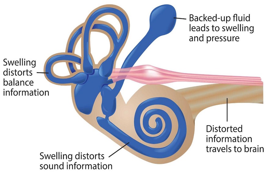 Menieres Disease Symptoms And Treatments Be Pixel Lung 